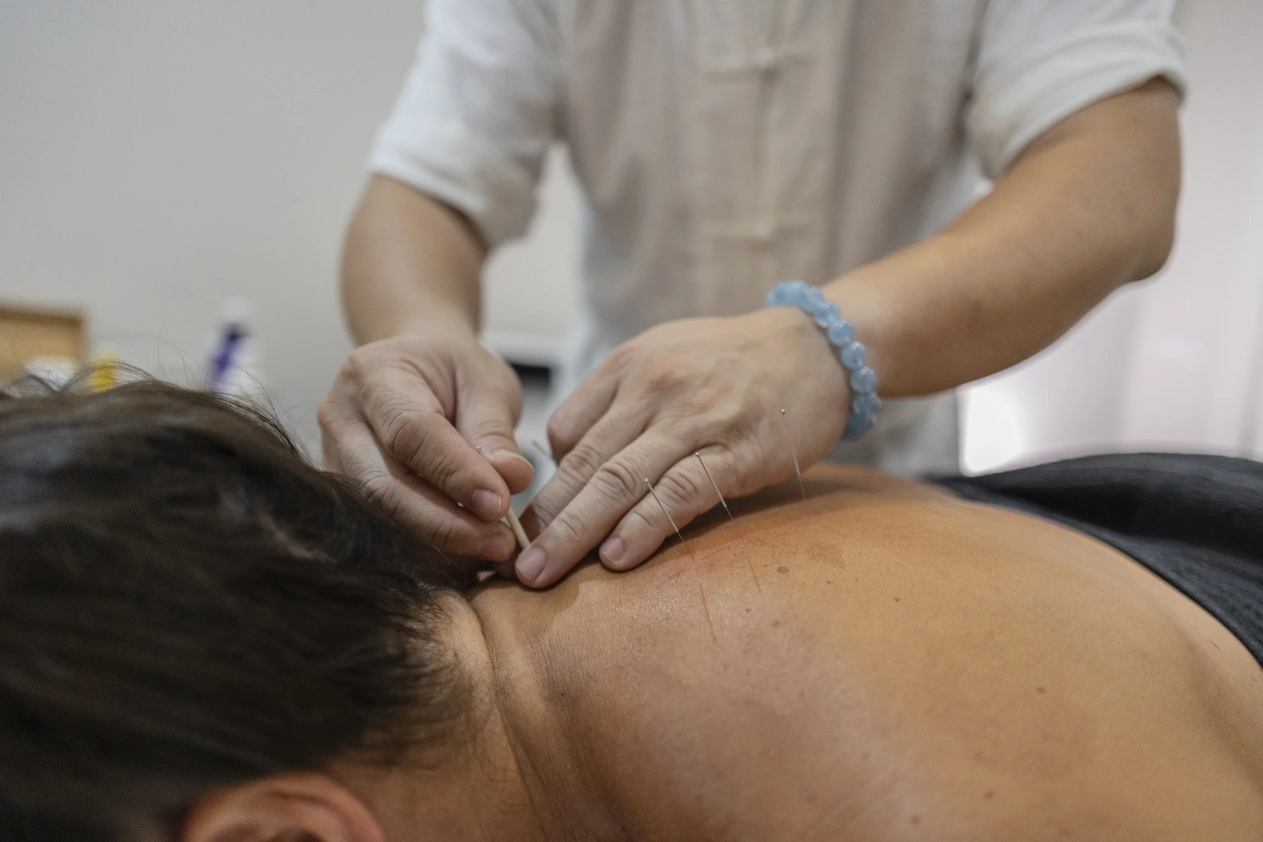 Acupuncture Calgary treatment with needles applied to a patient’s upper back