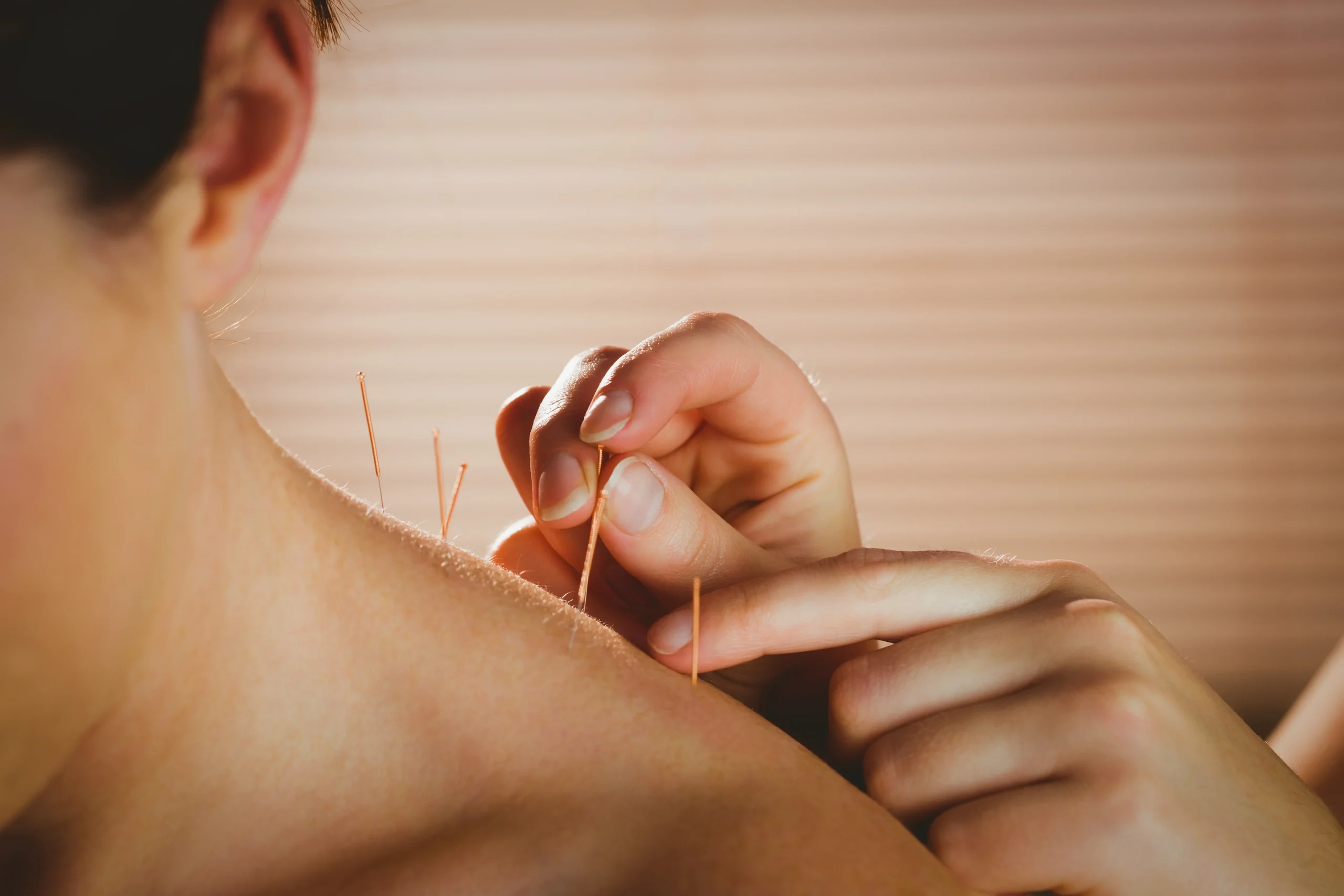 Dry Needling Calgary physiotherapist performing a dry needling treatment for muscle tension